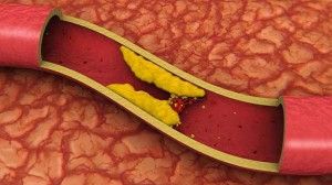 Arterias Colesterol
